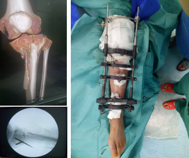 Representative clinical cases of worm gear and worm three-dimensional reconstruction external fixator